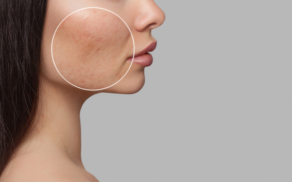 Acne bellafill scar treatment