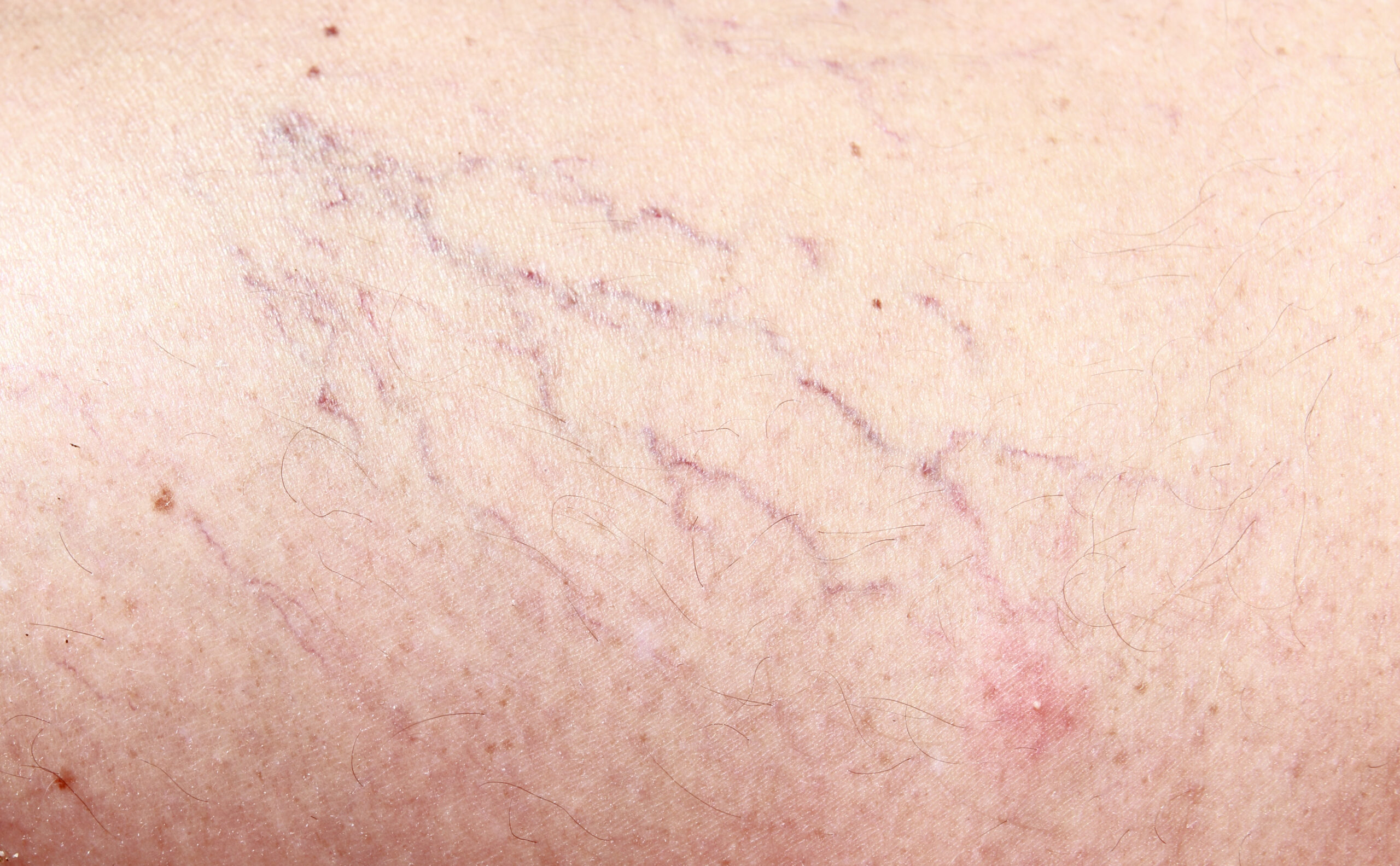Broken capillaries and treatment