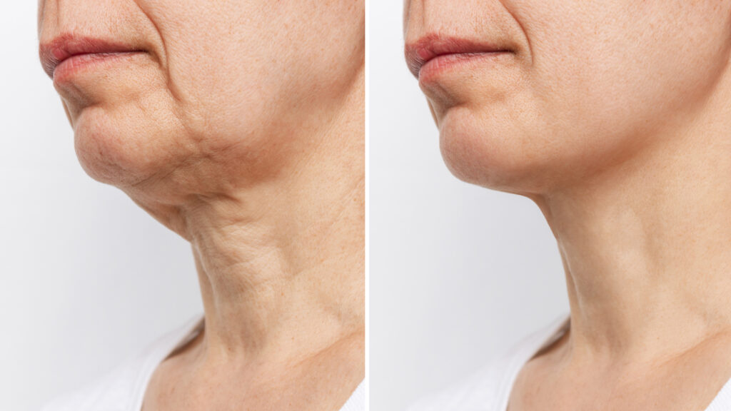 facelift procedure