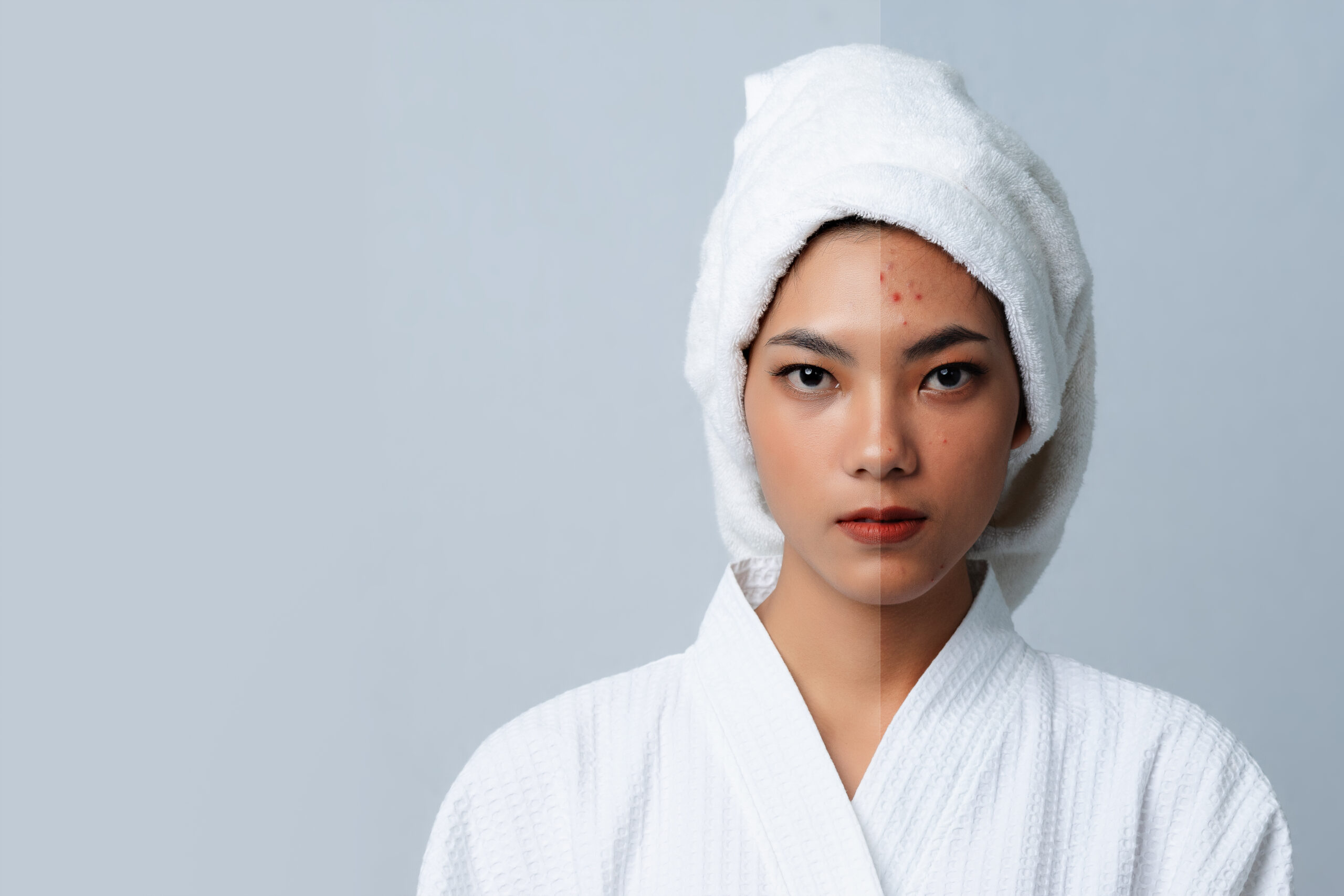 hyperpigmentation treatment