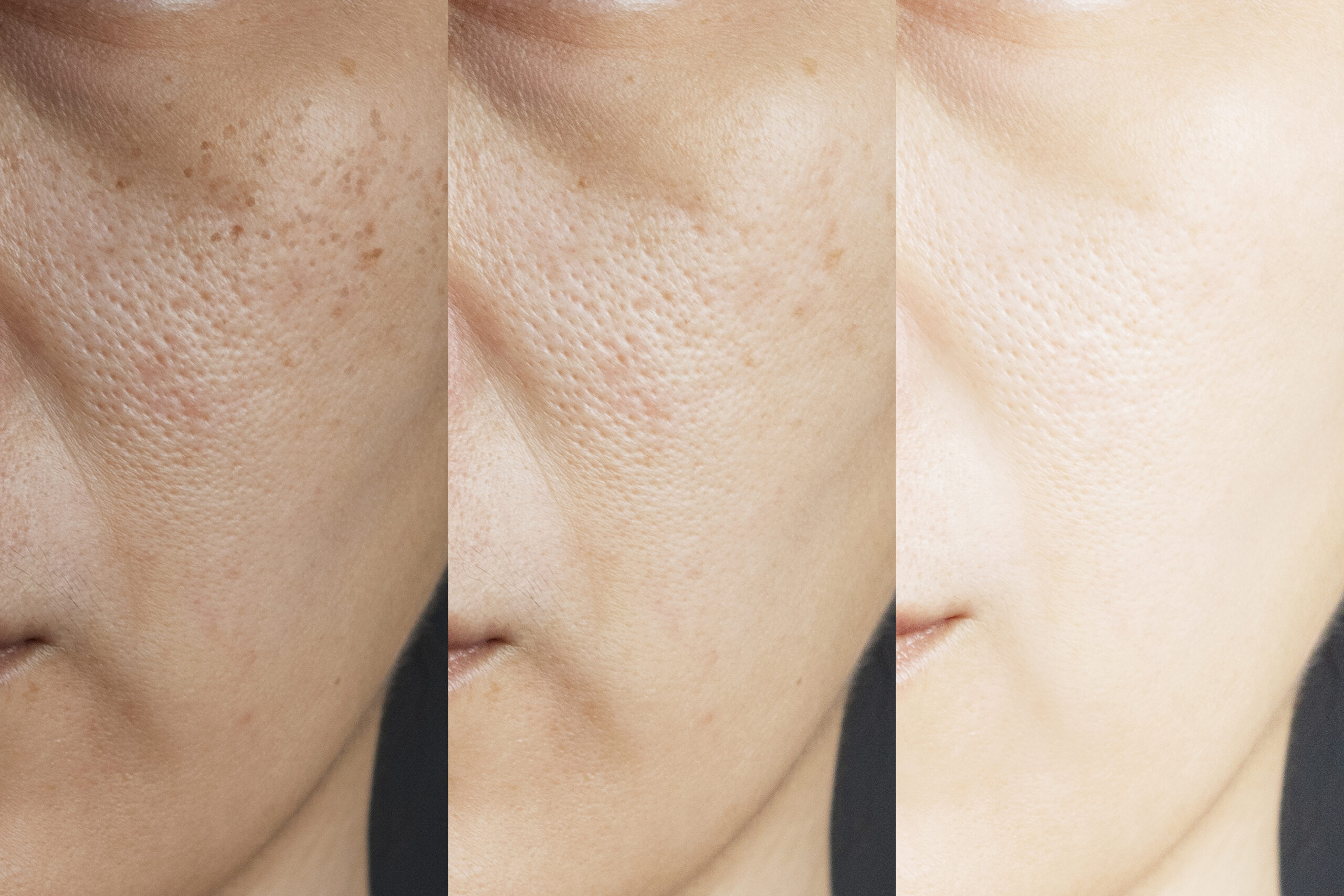 large pore treatment