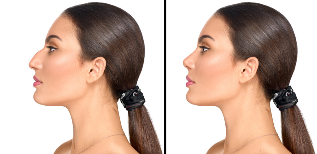 rhinoplasty procedure