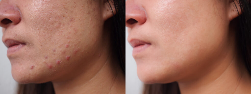Salt renewal facial