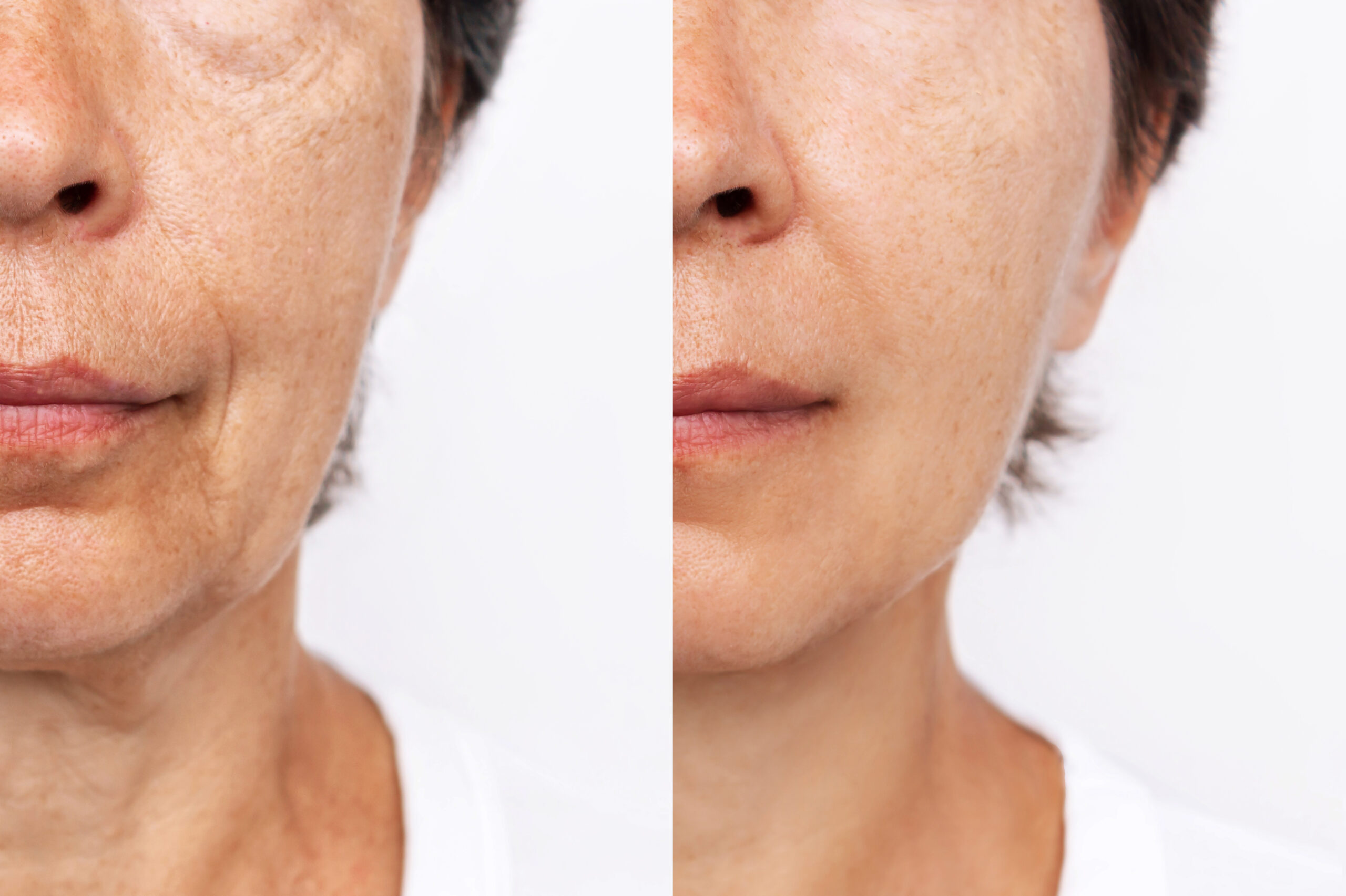 Bellafill filler