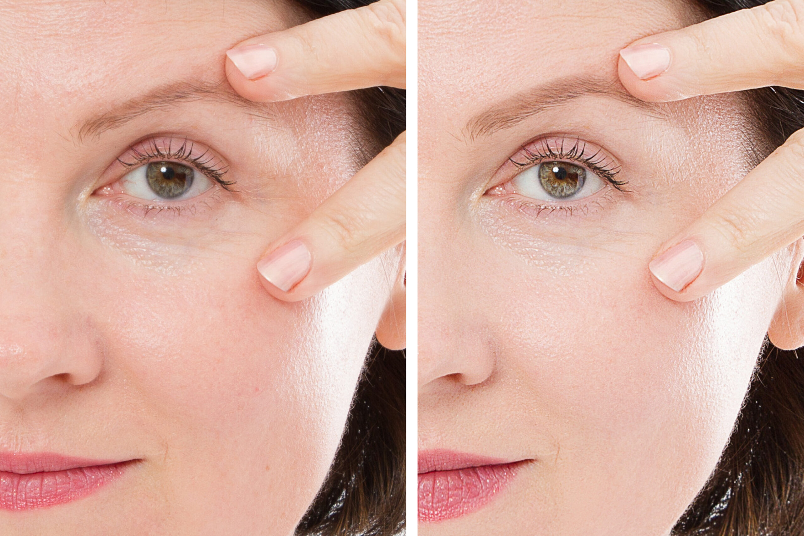 Belotero filler under eye