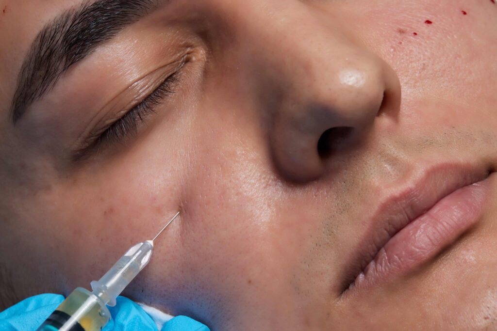 PRP microneedling