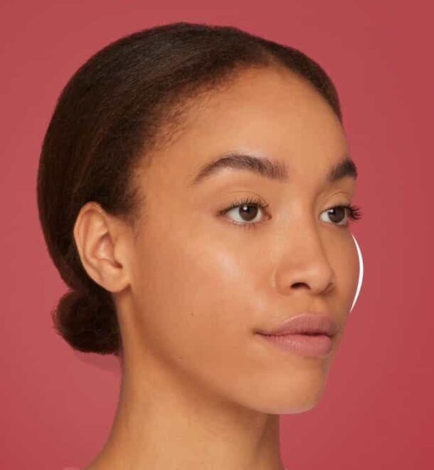 Restylane Contour