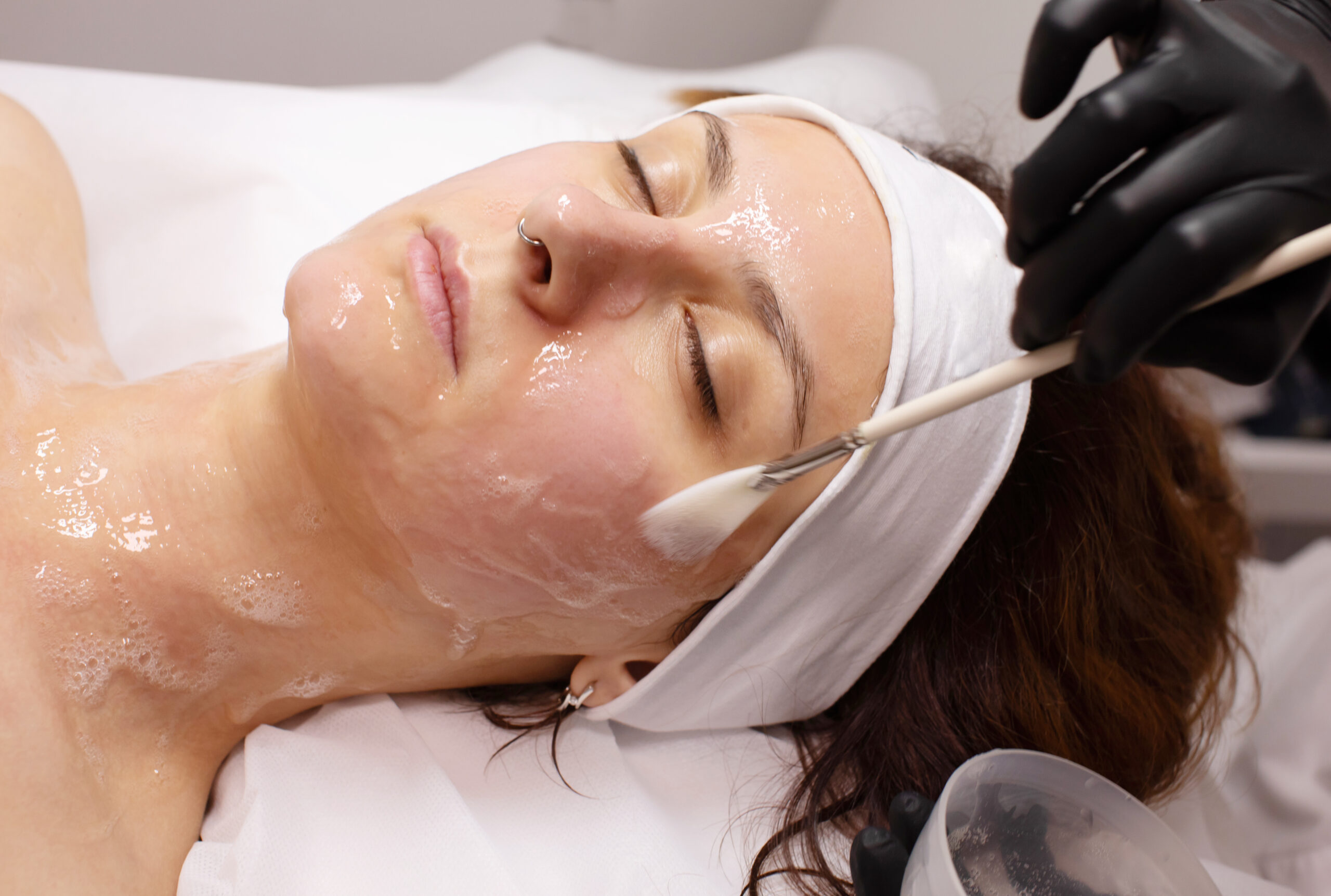 glycolic acid peel