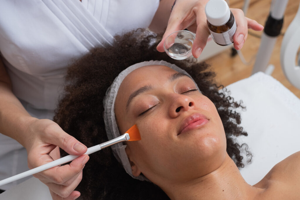 Lactic acid chemical peel