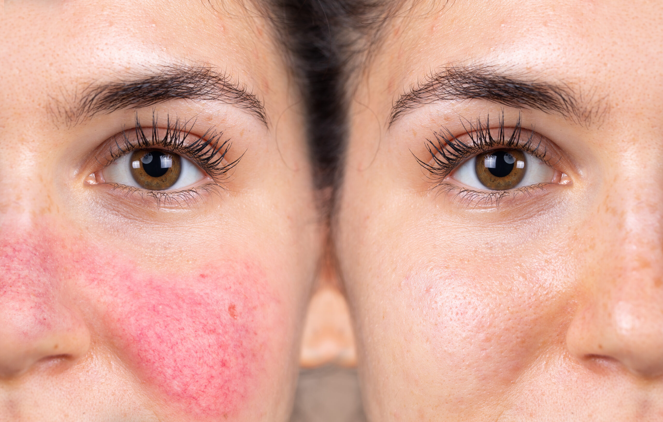 PDL laser treatment