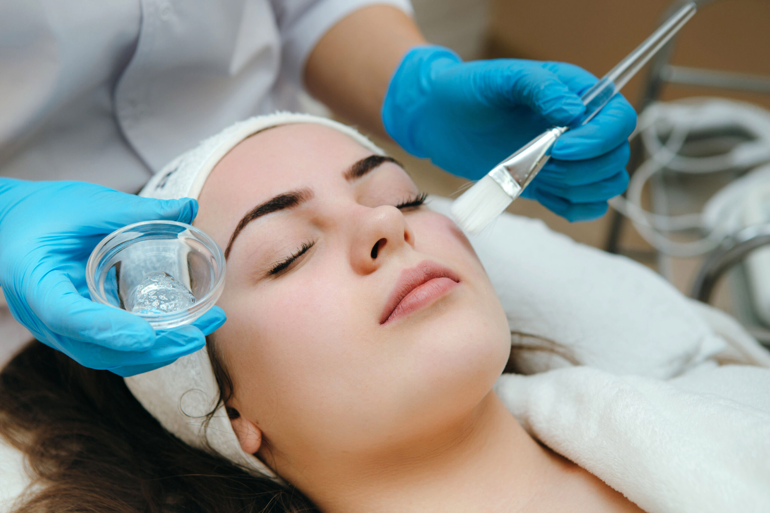 Salicylic acid peel for acne