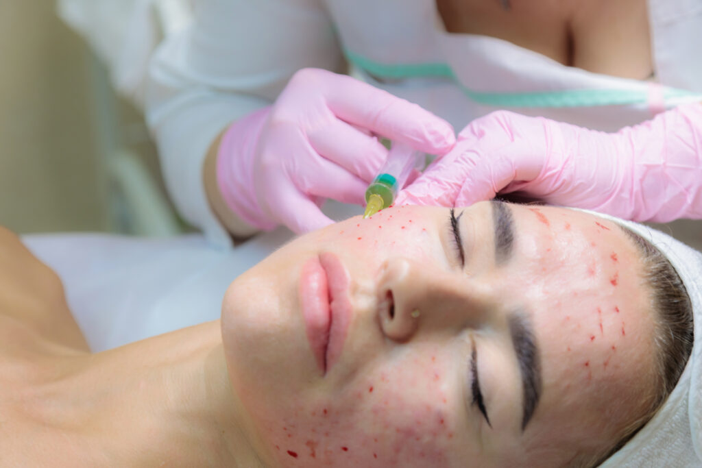 vampire facial