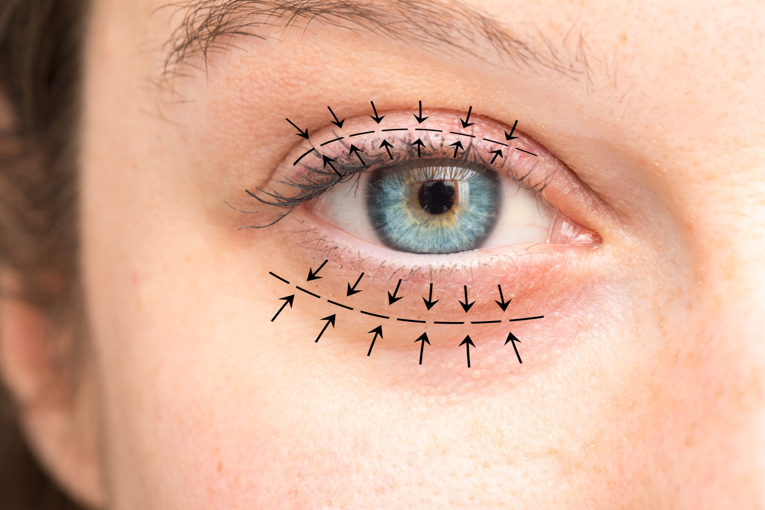 blepharoplasty surgery