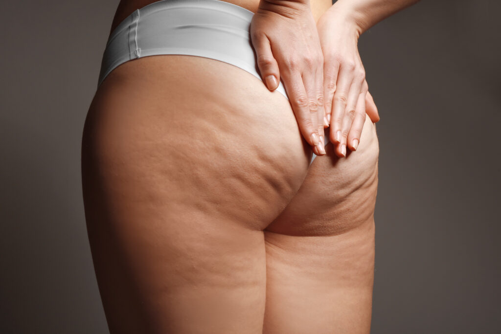 Cellulite and treatments for it.