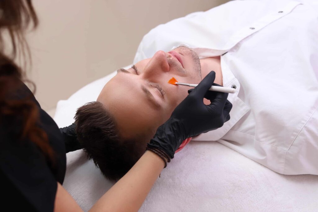 PRX chemical peel treatment