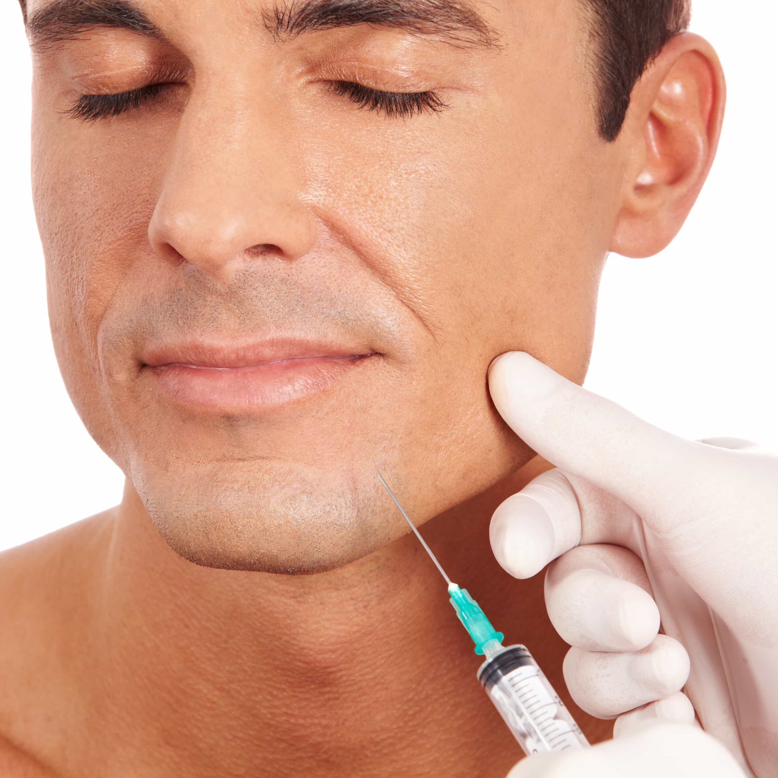 Radiesse filler