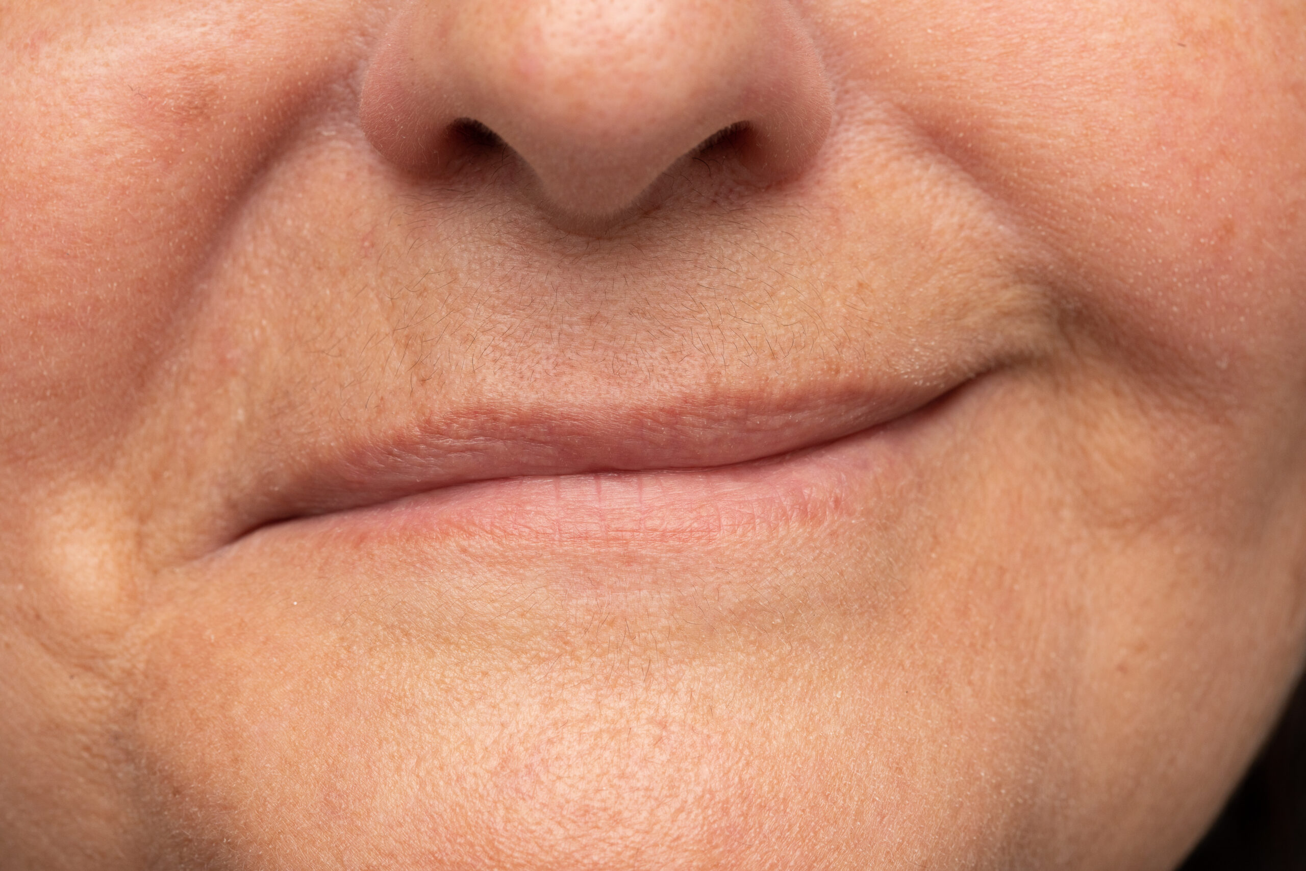 Bells palsy tox