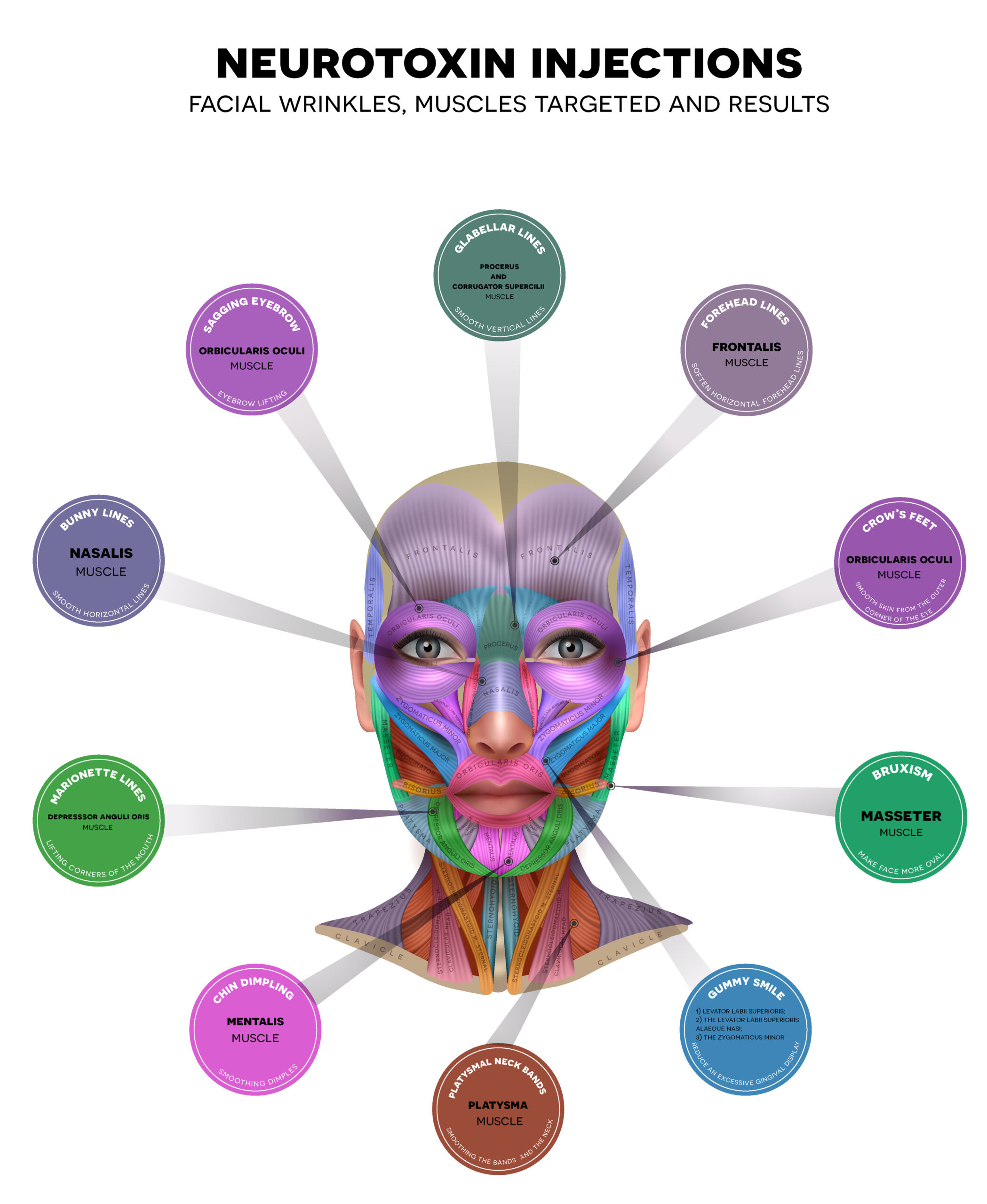Neurotoxin injection sites for wrinkles
