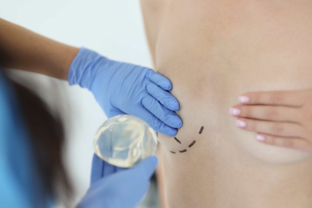 breast augmentation