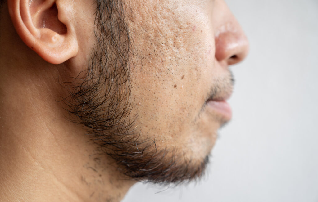 Acne scar treatment with HA filler