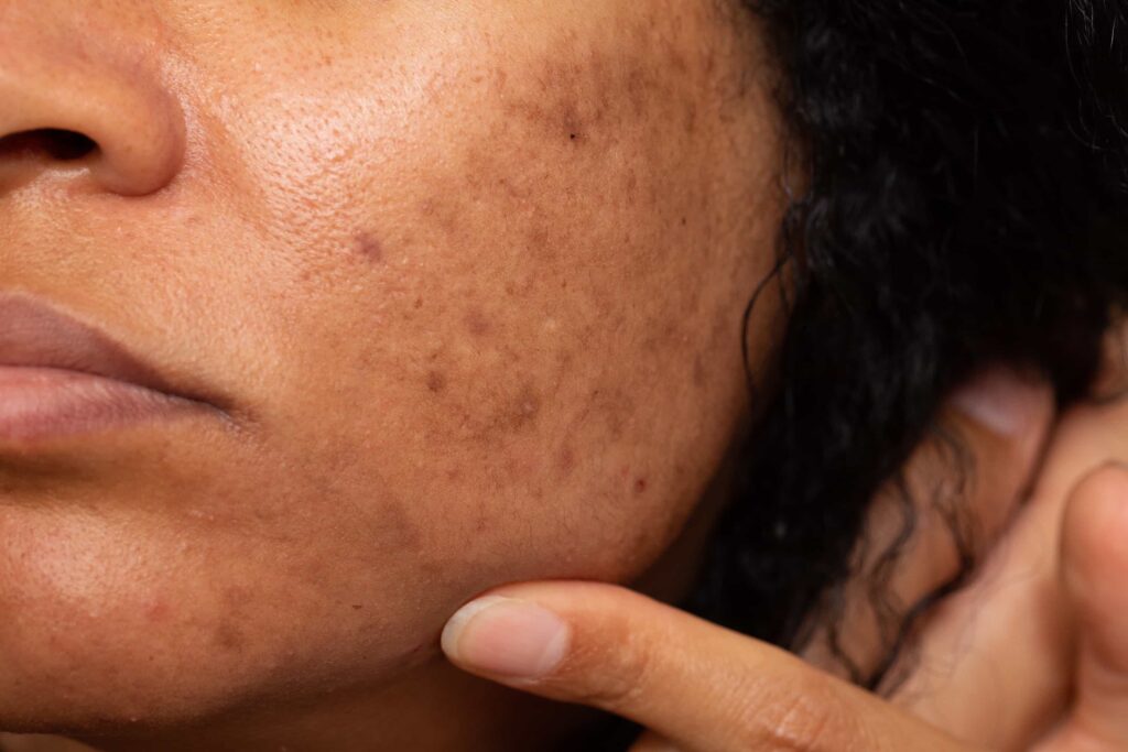 cosmelan peel for melasma