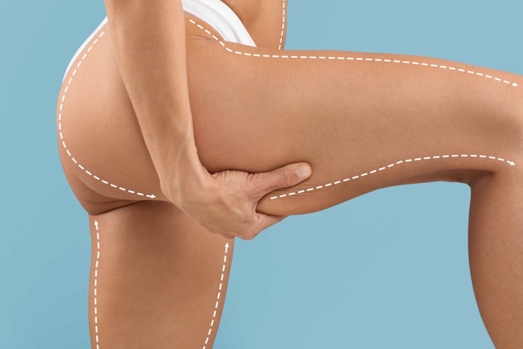 thigh lift procedure