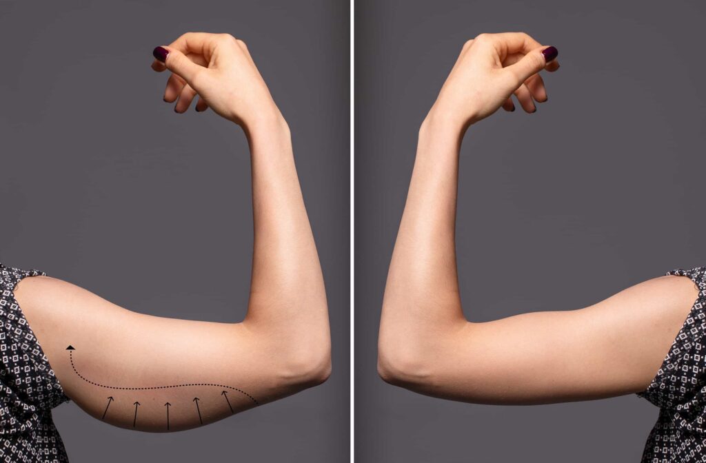 arm lift (brachioplasty)
