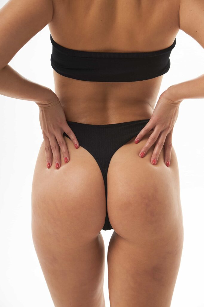butt implants