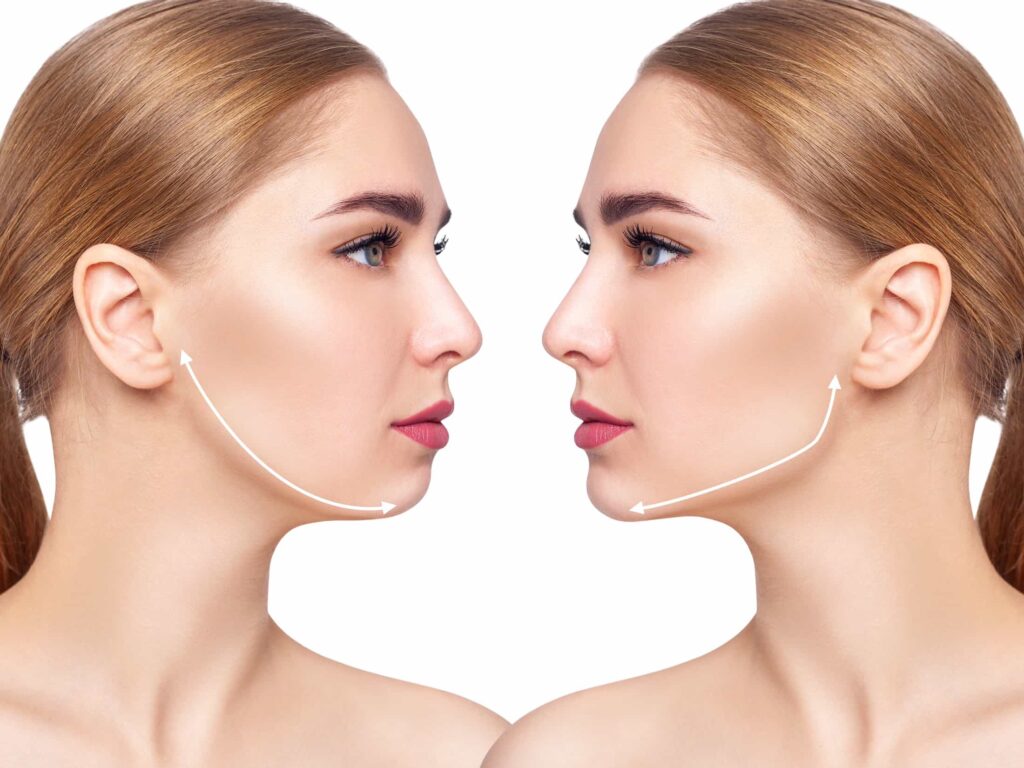 chin implant