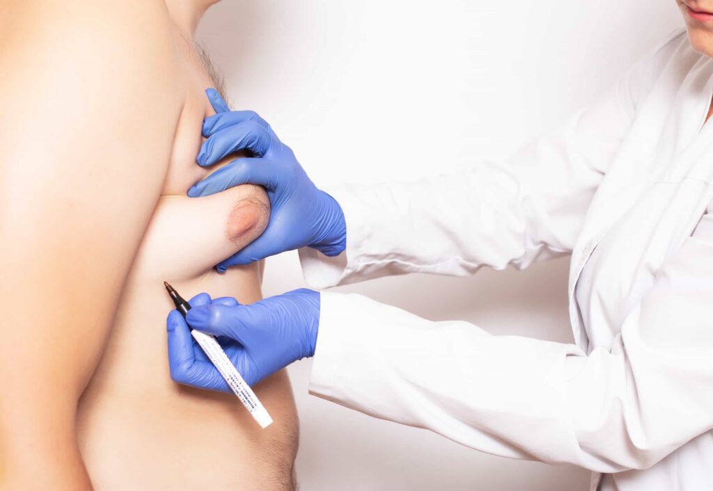 gynecomastia