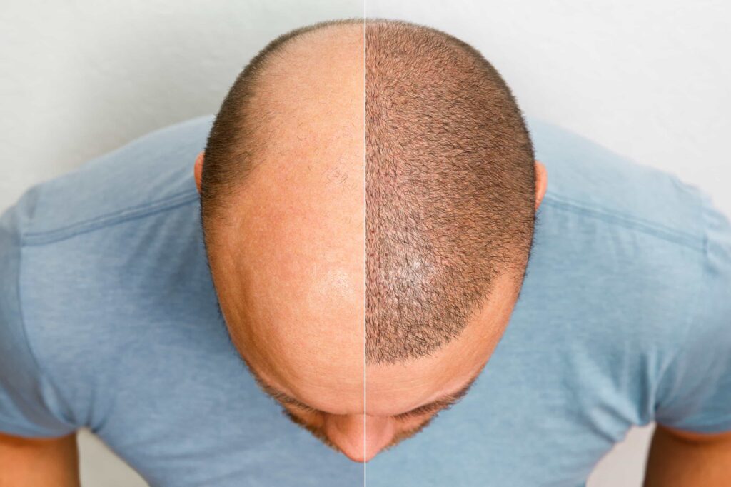 hair transplant procedure