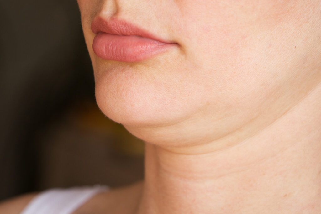 neck liposuction