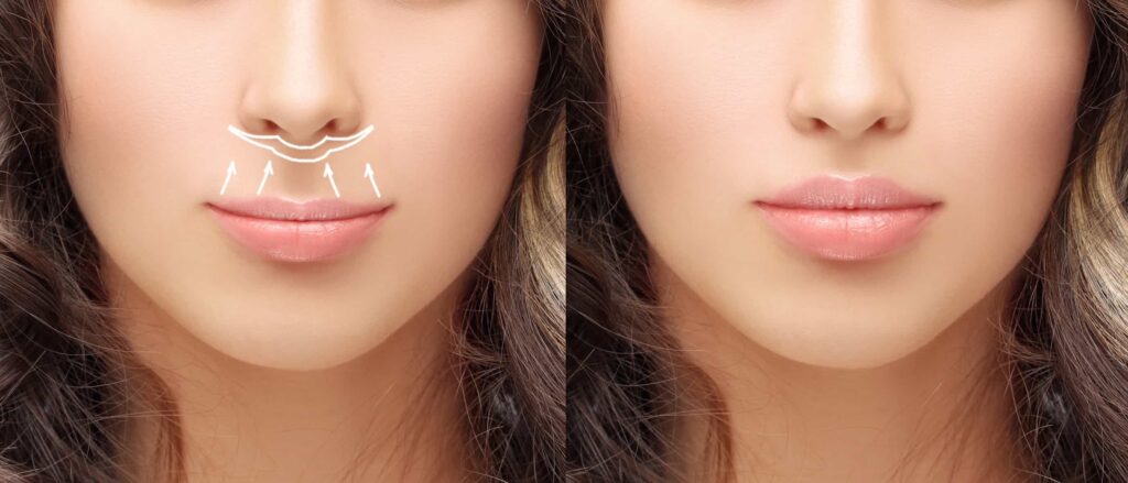 Lip lift procedure
