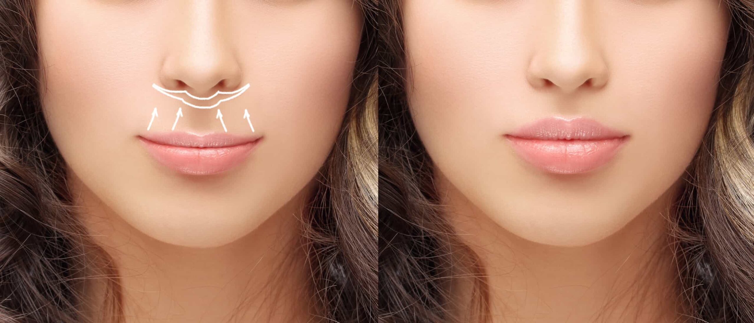 Lip lift procedure