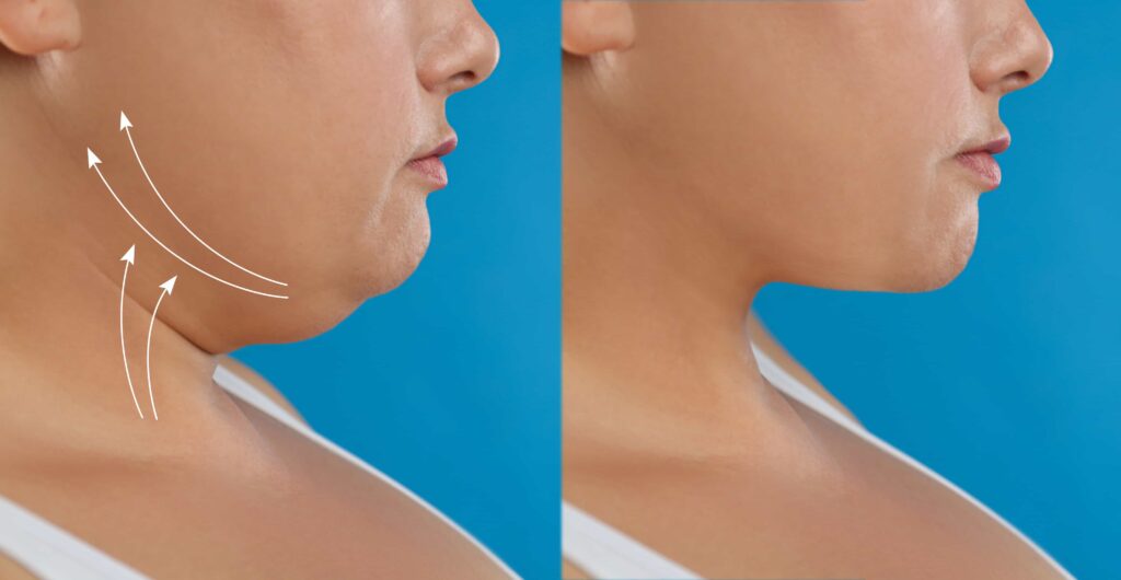 neck lift procedure