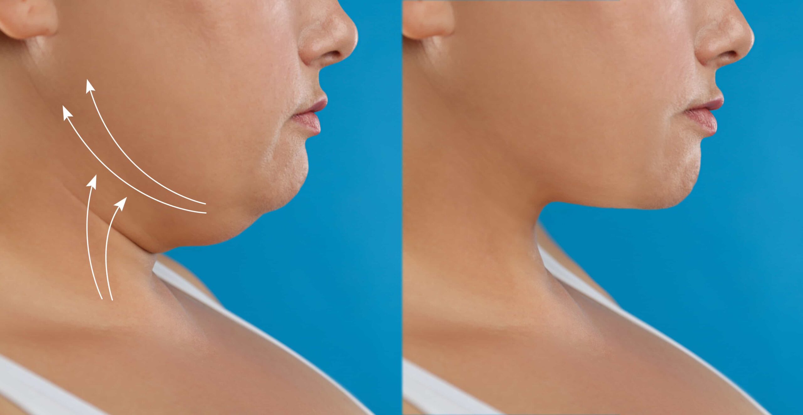neck lift procedure