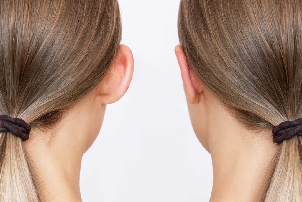 otoplasty procedure
