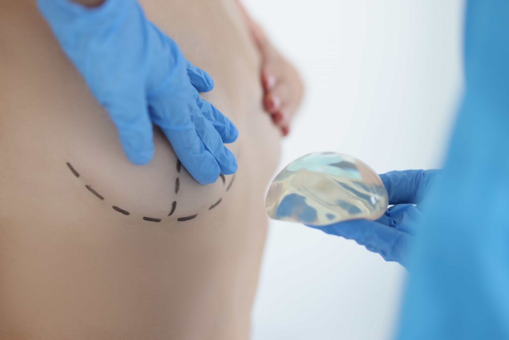 breast implant with lift