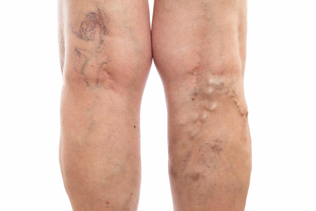 Varicose veins treatment