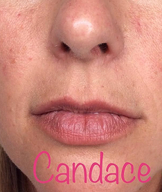 candance-before