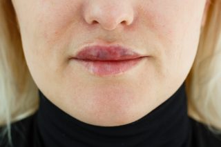 Aesthetic complications and answers