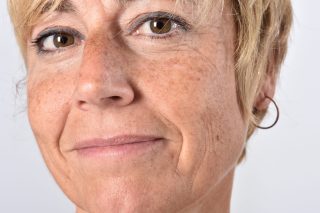Identifying age spots and how to treat them.