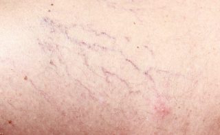 Broken capillaries and treatment