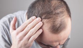 Hair loss treatment