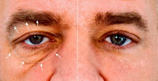 hooded eyes treatment