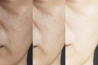 large pore treatment