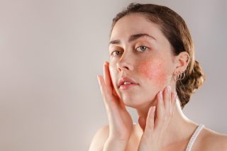 Rosacea treatments