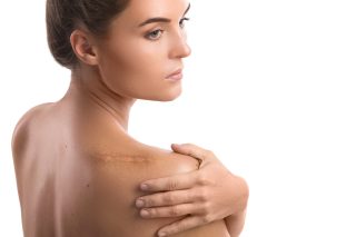 Scar treatments