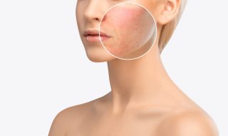 skin redness condition and treatments
