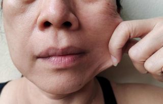 skin laxity treatment